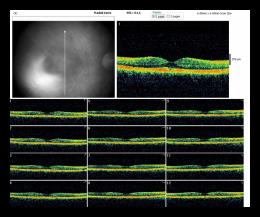 RADIAL LINE OD